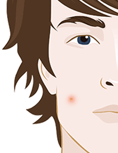 How to treat infected acne safely