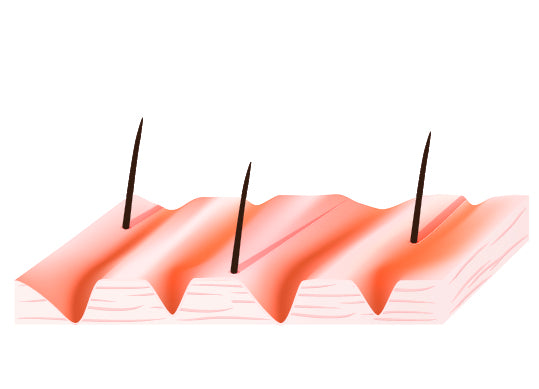 What is xerosis of skin and how to treat it