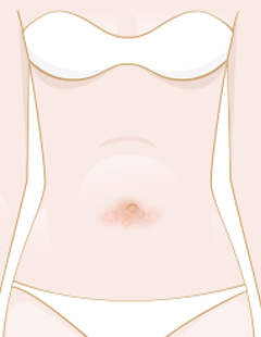 How to manage eczema bleeding