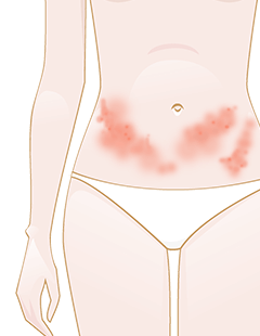 Shingles  Good advice for treating and preventing shingles