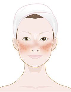 What causes whiteheads on face