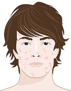 Acne Inflammation: What It Means and How to Treat It