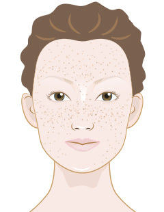 What causes cystic acne?