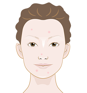 What causes little acne bumps on face