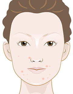 Pimples on the face - How to reduce and minimise pimples