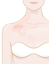 Hives/Urticaria