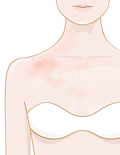 Hives/Urticaria