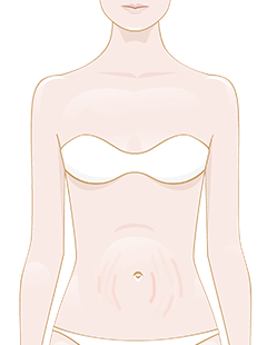 Reduce the visibility of stretch marks on the breasts