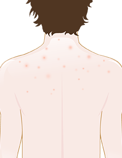 how to get rid of spots on back