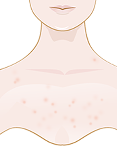 spots on chest