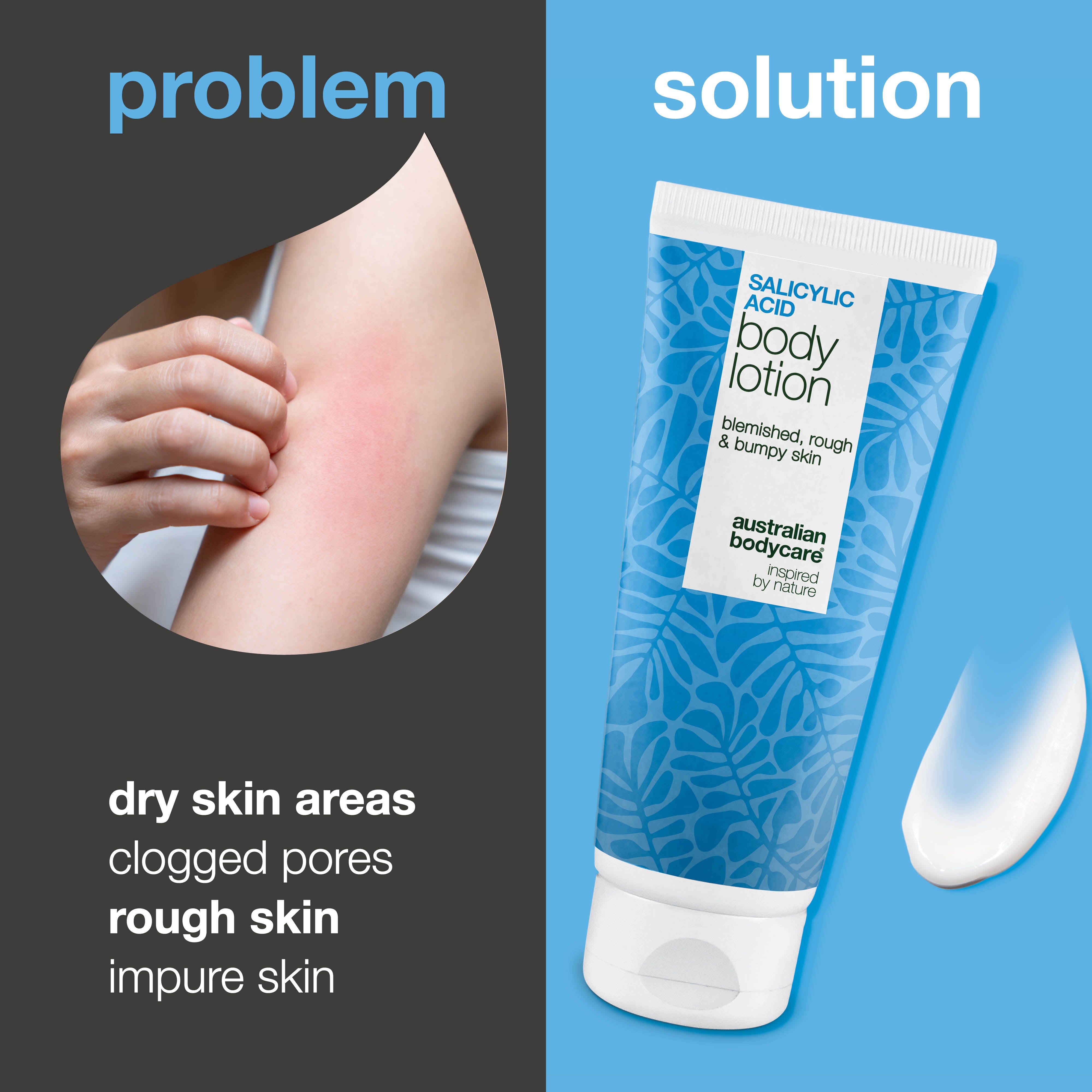 Body lotion with salicylic acid – for blemishes and dry skin — Body lotion with salicylic acid exfoliates, hydrates, and helps reduce blemishes, uneven texture, and dry skin. Perfect for daily use.