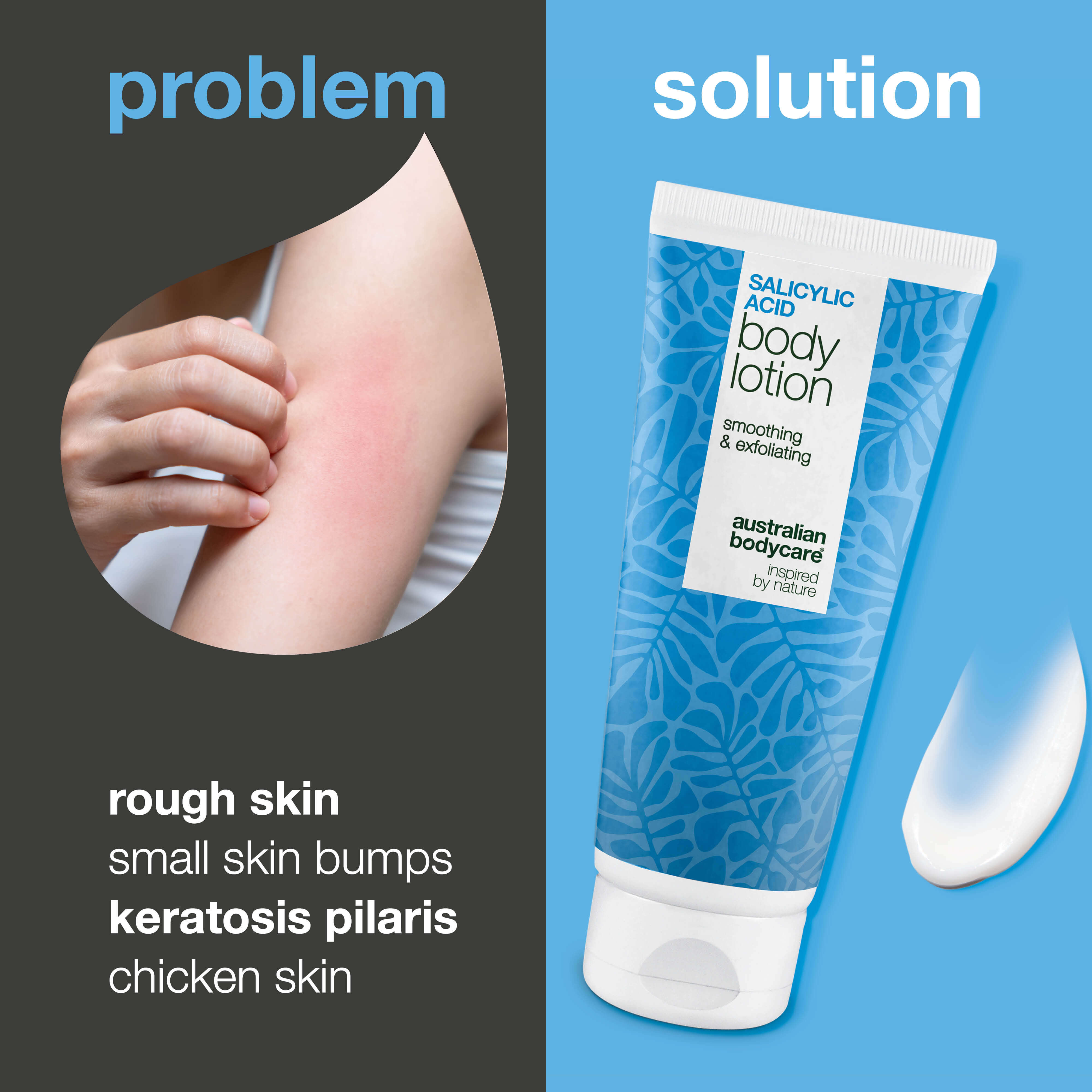 Keratosis Pilaris Body Lotion smooths rough, dry skin and bumps. Ideal for chicken skin. Contains salicylic acid, niacinamide and zinc PCA.