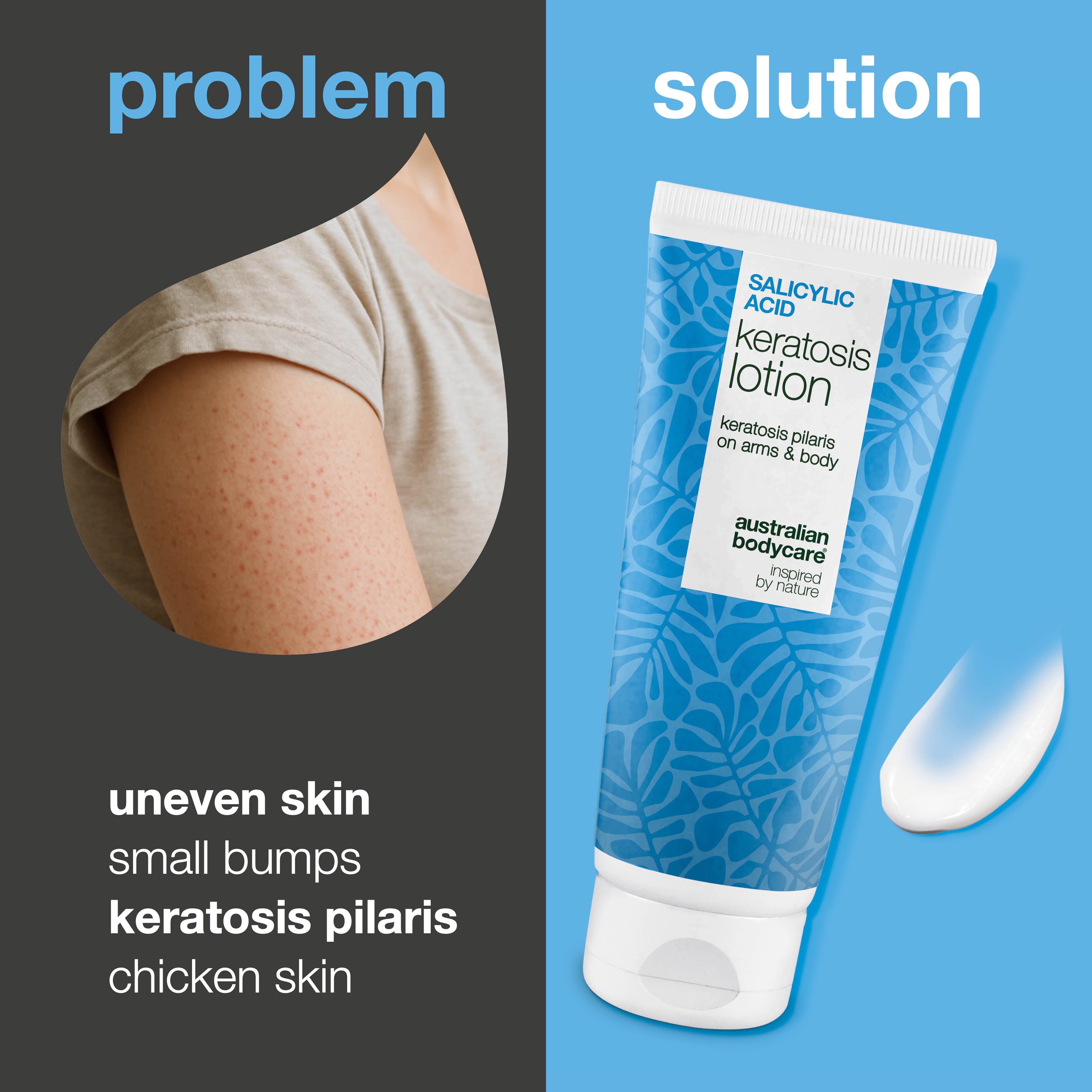 Body lotion for keratosis pilaris and rough, bumpy skin — Body lotion for keratosis pilaris and dryness. Smooths skin with salicylic acid, niacinamide, and zinc.