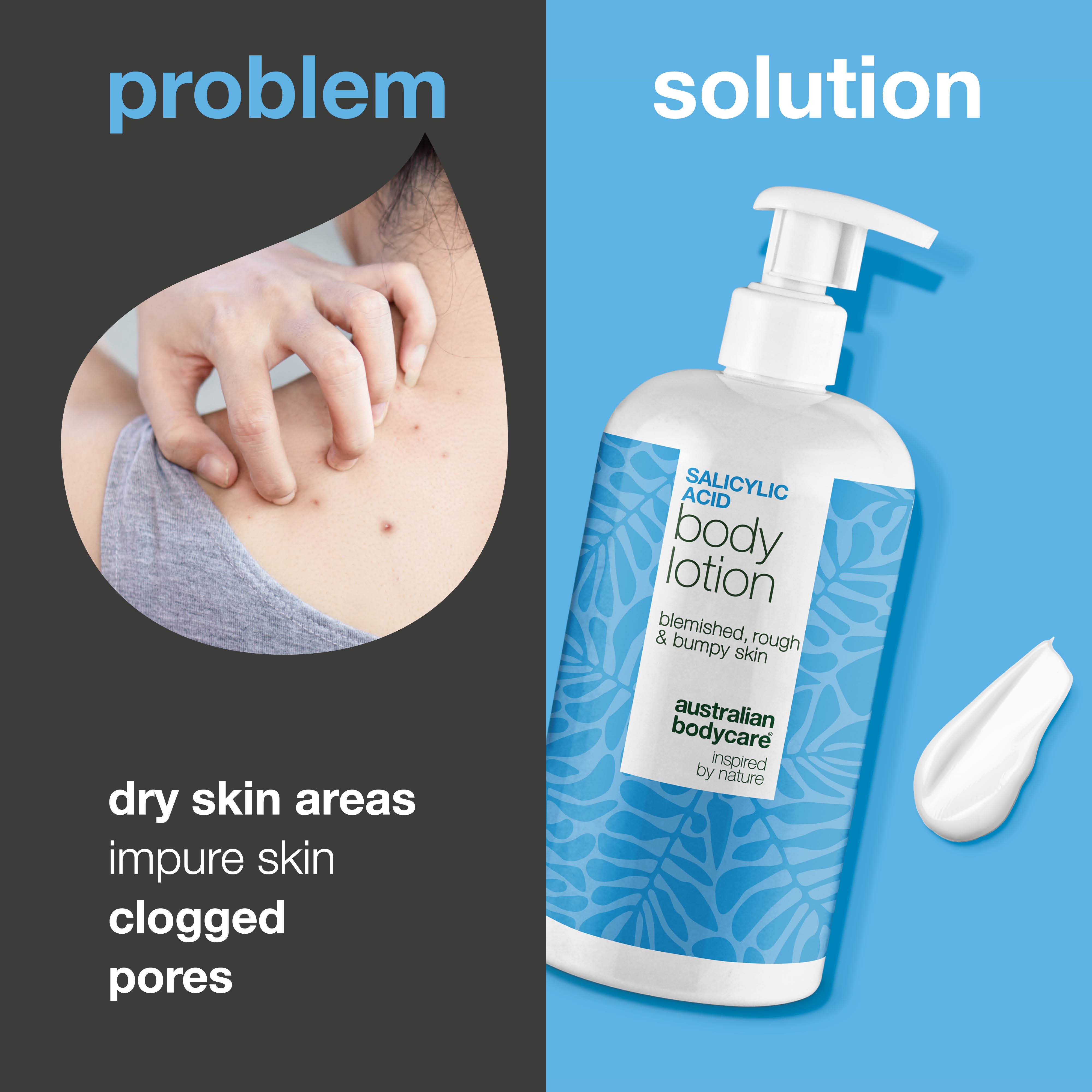 Body lotion with salicylic acid – for blemishes and dry skin — Body lotion with salicylic acid exfoliates, hydrates, and helps reduce blemishes, uneven texture, and dry skin. Perfect for daily use.