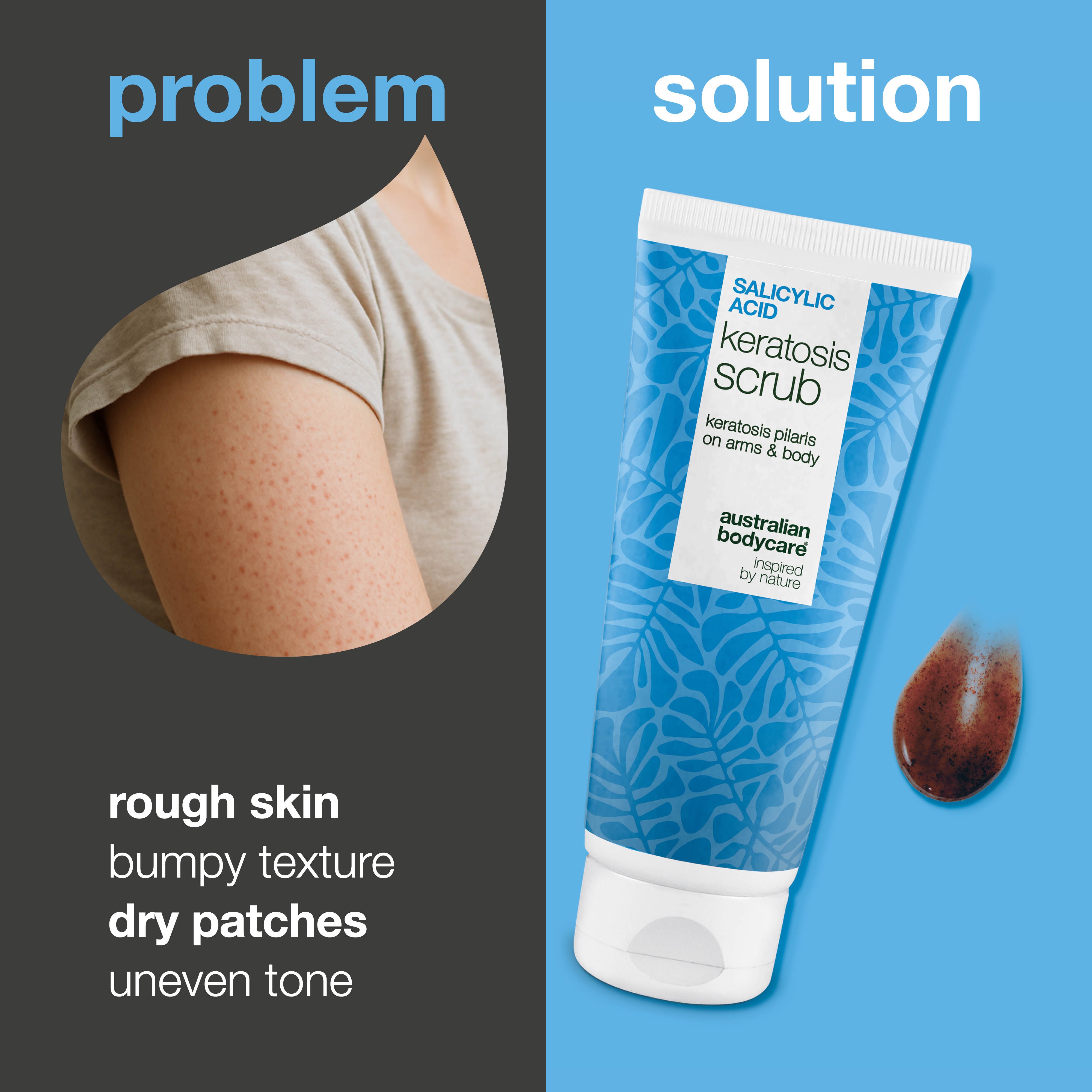 Keratosis Pilaris Body Scrub removes dead skin and reduces bumps. Smooths and hydrates with Salicylic Acid, Glycolic Acid, and Allantoin.