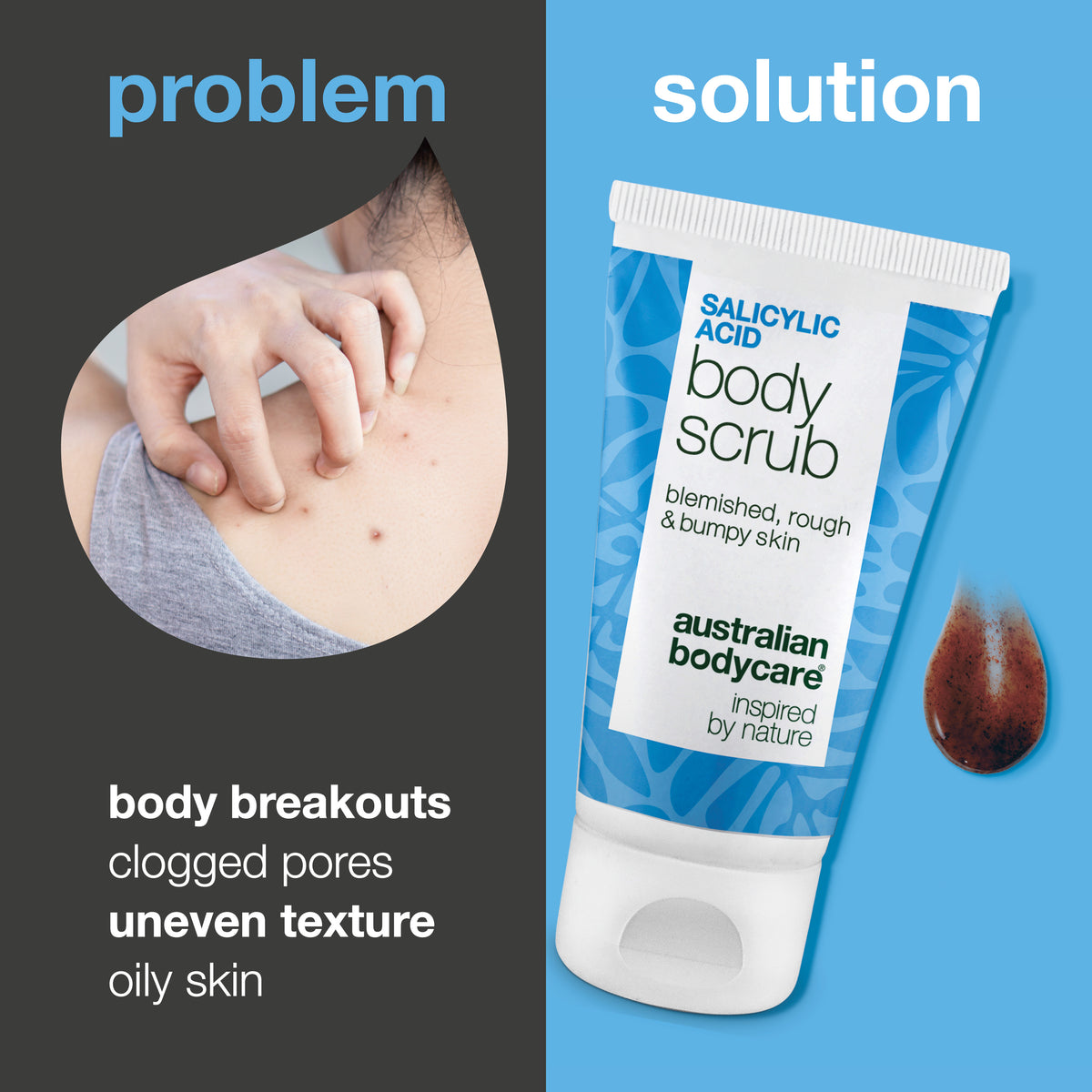 Problem and solution: body breakouts, clogged pores, uneven texture and oily skin. On the left a close-up of a shoulder with spots, on the right the Salicylic Acid Body Scrub from Australian Bodycare