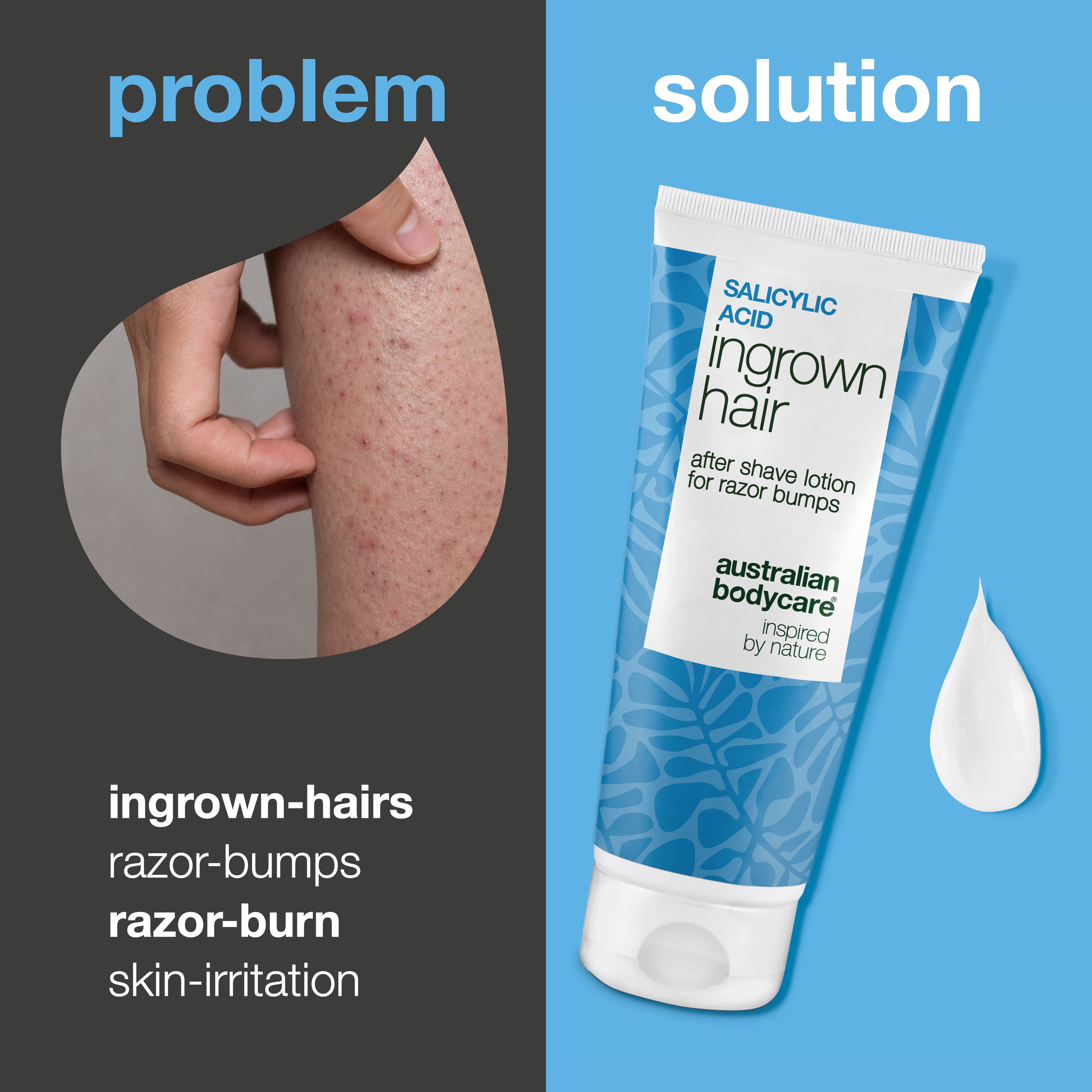 Salicylic Acid After Shave Lotion for ingrown hairs, red bumps and post-shave irritation. The product is shown next to skin with visible red bumps and ingrown hairs.