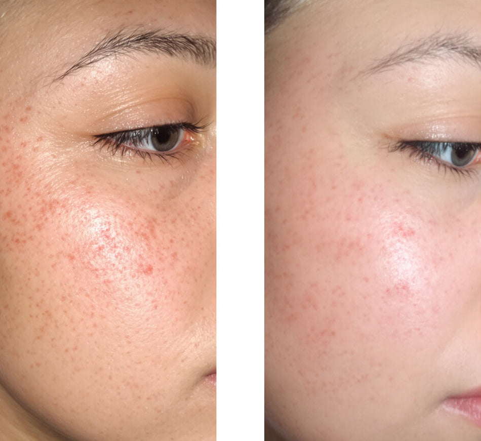 Salicylic Acid 2% Serum for Oily Skin, Blackheads & Blemish Control