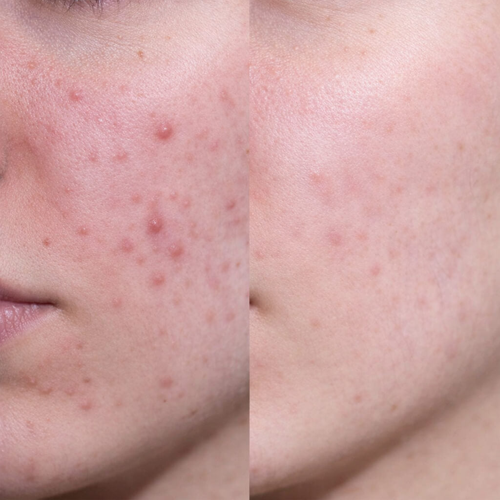 Before and after image of a customer showing clearer skin with fewer pimples and reduced redness after using salicylic acid face cream.