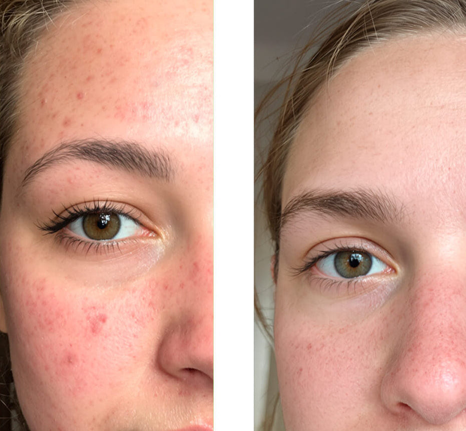 Before/after image of a customer using our 2% Salicylic Acid Face Toner/Peeling/Exfoliant, showing great improvement in the skin with fewer pimples and blemishes.