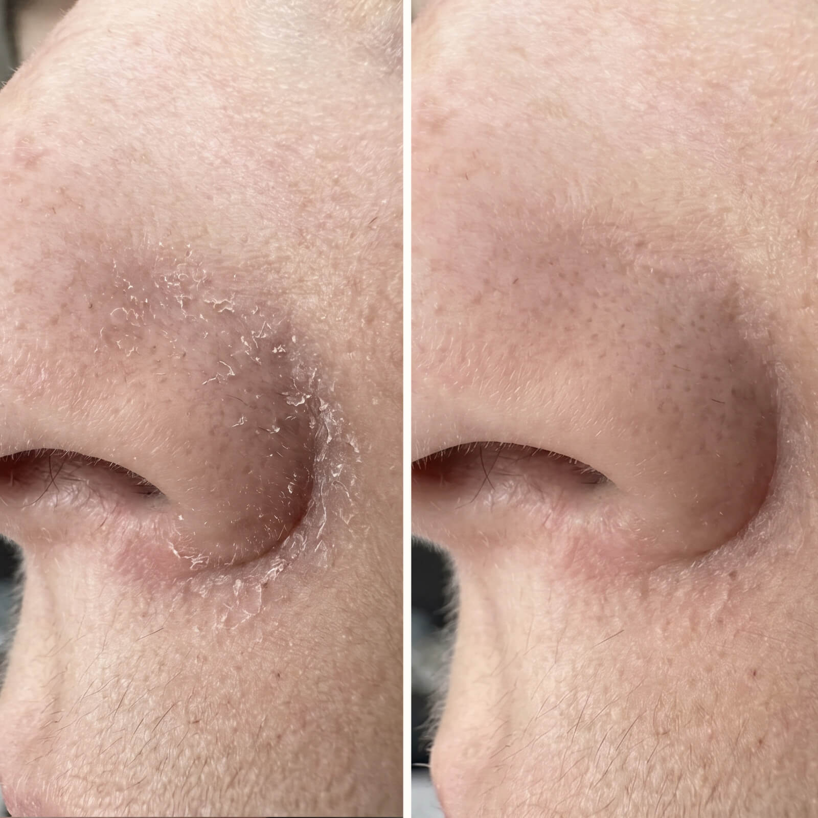 Salicylic Acid Serum – For Beard & Facial Dandruff — Effective serum for beard dandruff and seborrheic dermatitis. Salicylic Acid clears flakes and redness fast to restore skin balance.