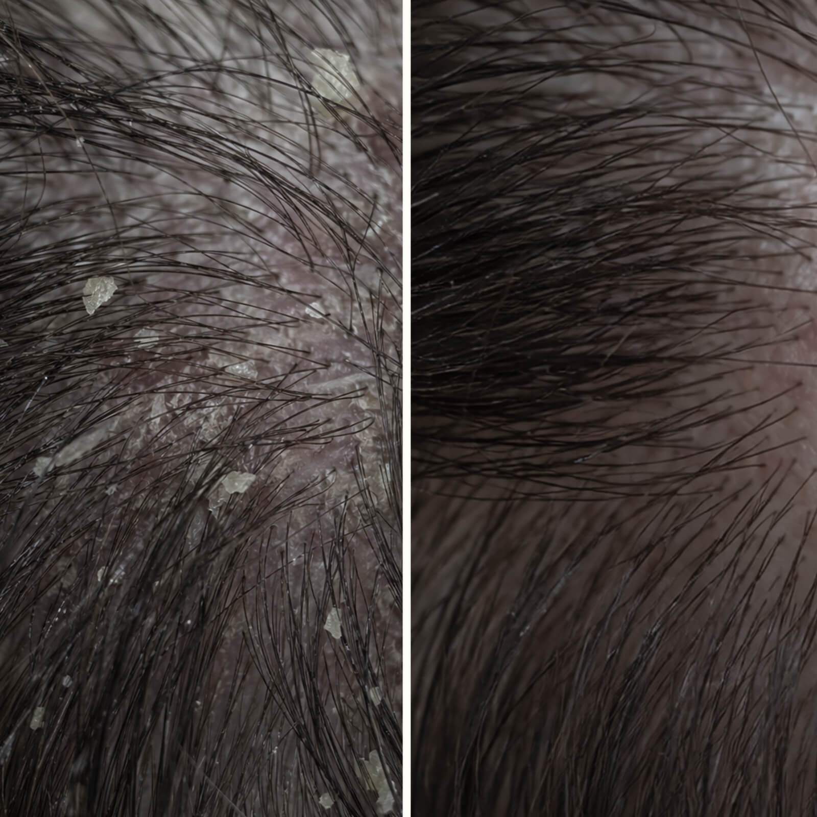 Salicylic Acid Scalp Treatment for oily & flaky scalp — Salicylic Acid Pre-Wash Treatment relieves itchiness, flakes, and oil. Use before washing for deep exfoliation with active Salicylic Acid.