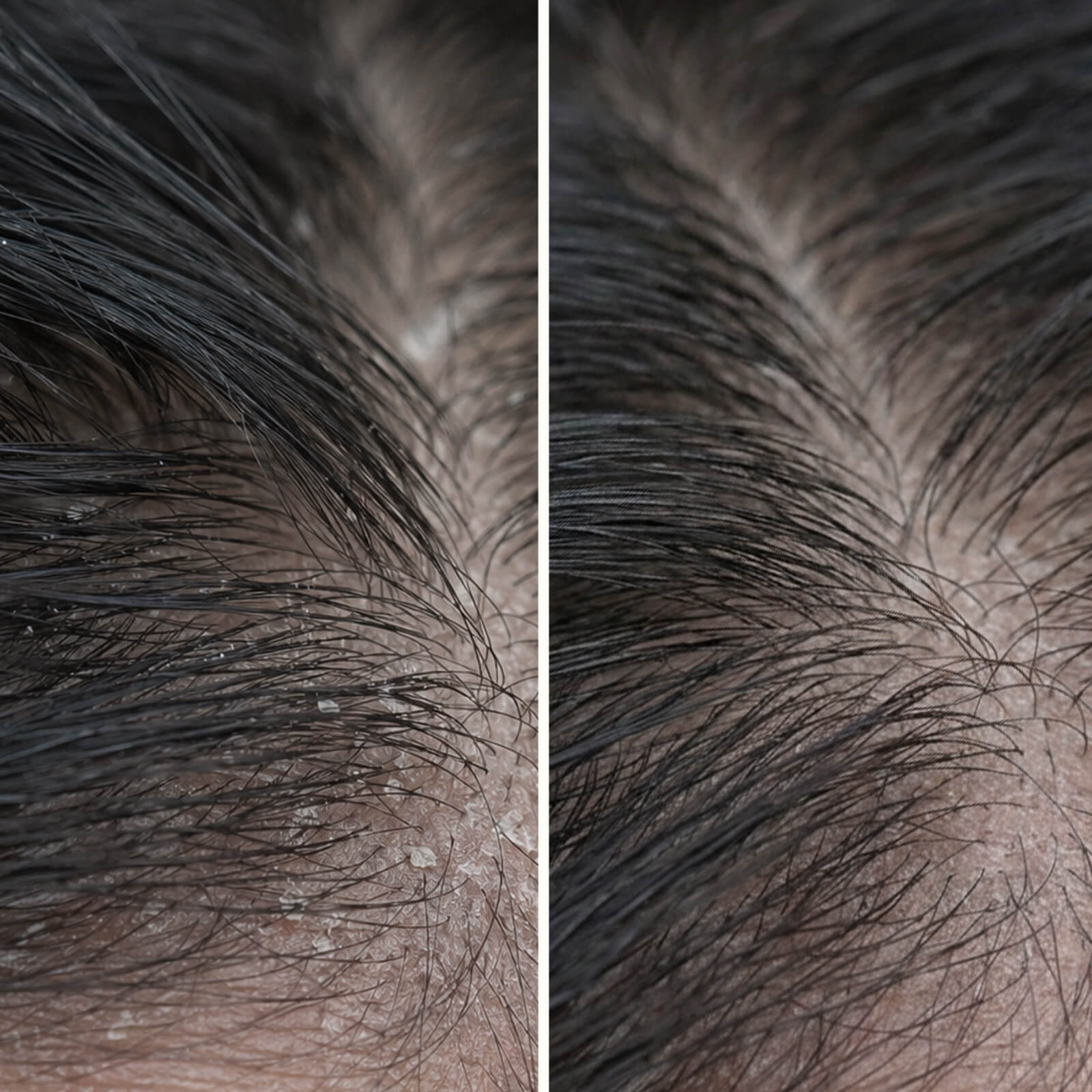Salicylic Acid Scalp Treatment for oily & flaky scalp — Salicylic Acid Pre-Wash Treatment relieves itchiness, flakes, and oil. Use before washing for deep exfoliation with active Salicylic Acid.