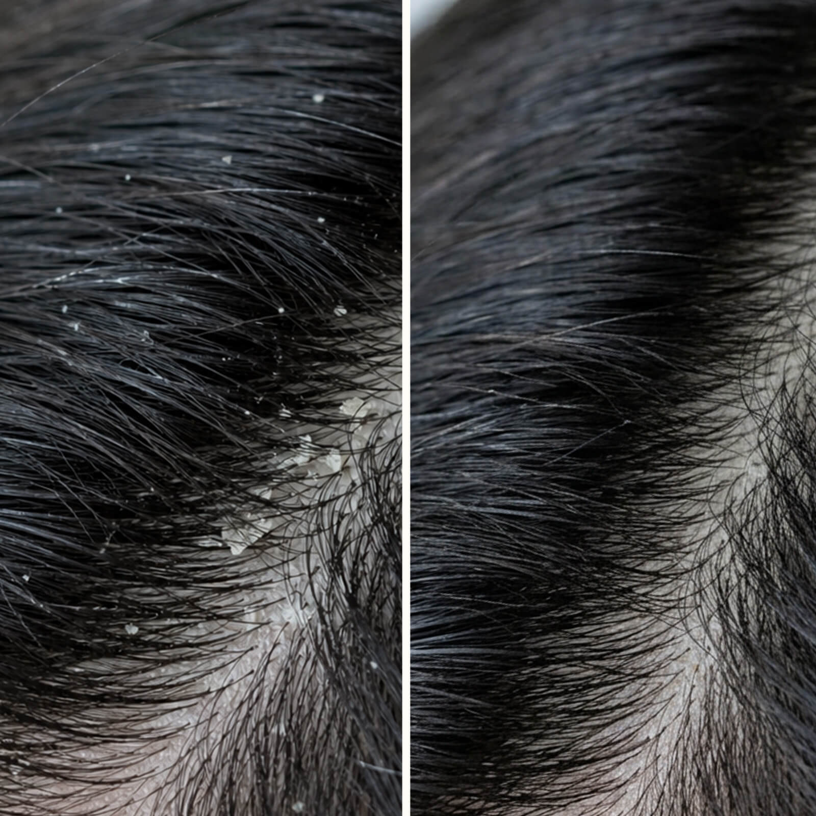Salicylic Acid Shampoo for Dry & Itchy Scalp — Get rid of an itchy scalp and dandruff with this shampoo. Soothes dry skin and removes dead skin cells with Salicylic Acid.