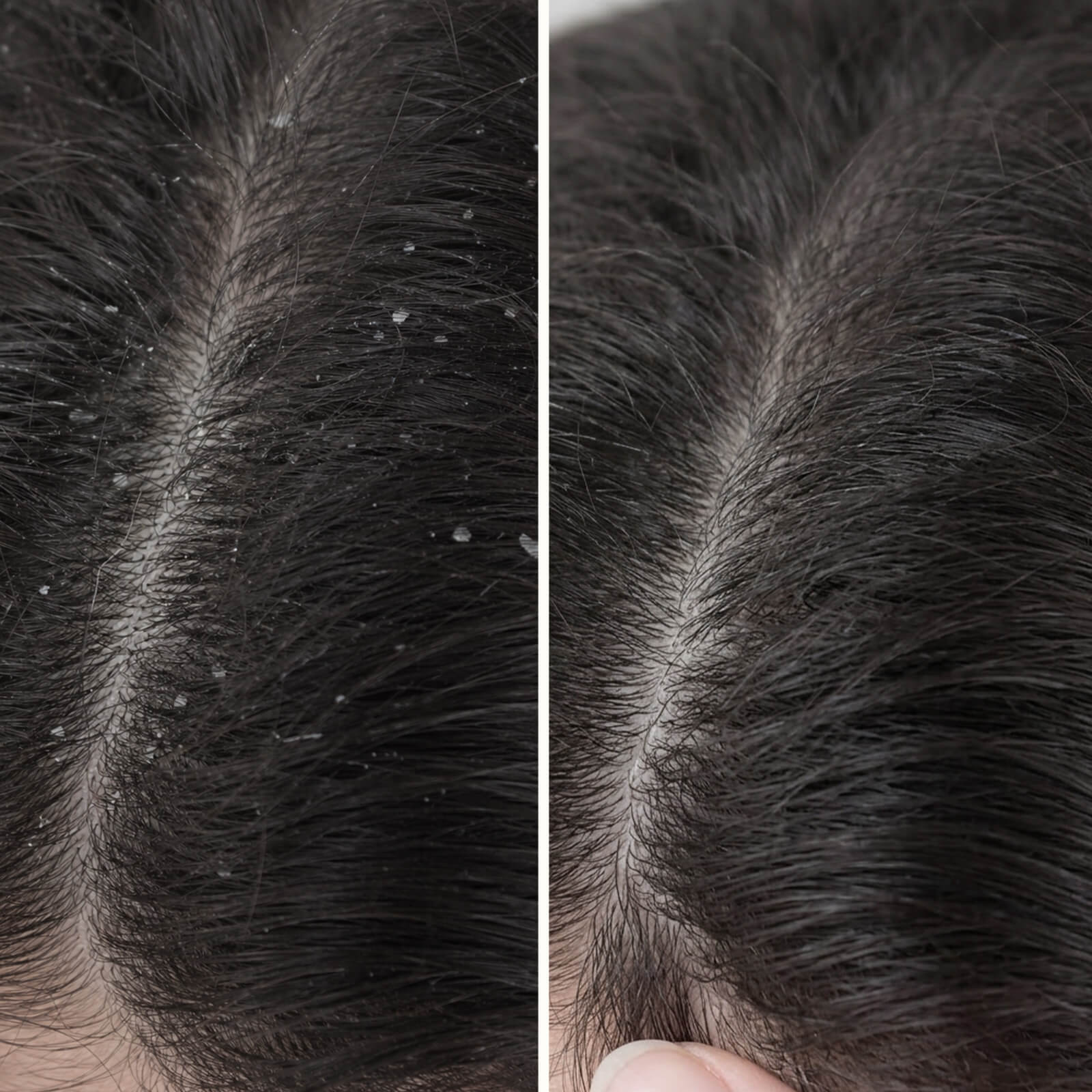 Salicylic Acid Conditioner for Dandruff & Itchy Scalp — Salicylic Acid Conditioner against dandruff and itchiness. Hydrates the scalp and strengthens hair. Effective care with Salicylic Acid.