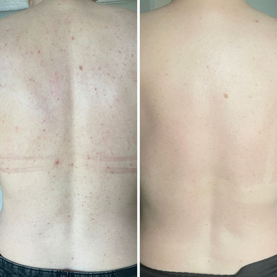 Before and after image of a person’s back showing visible pimples and acne in the 'before' photo, and a clear, smooth back free of blemishes after 4 weeks of consistent use of Australian Bodycare Salicylic Acid Body Spray.