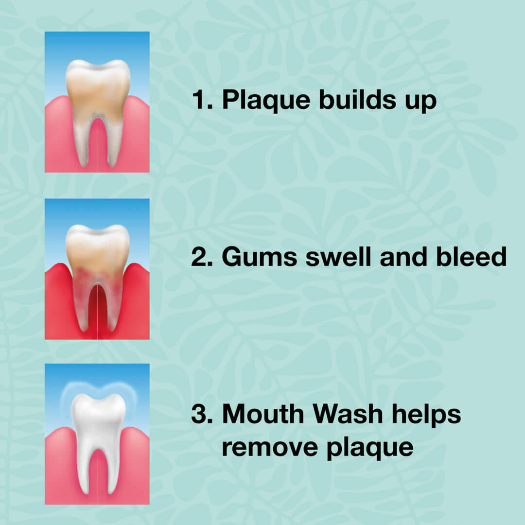 2 x mouthwash for bad breath and bad taste in the mouth — For daily care of thrush and gingivitis