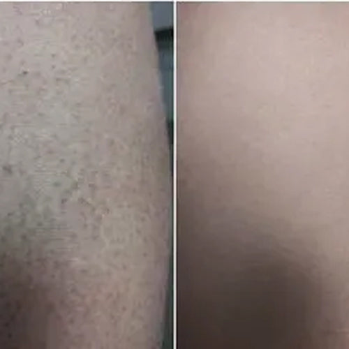 Alena's result after 2 weeks using the keratosis pilaris kit – visibly smoother skin on upper arms