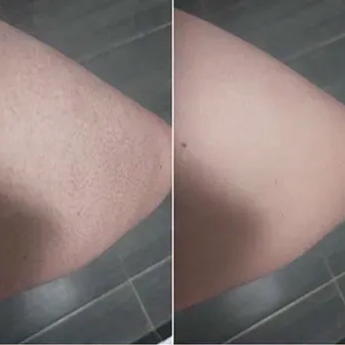 Alena's keratosis pilaris before and after – smoother skin after 2 weeks