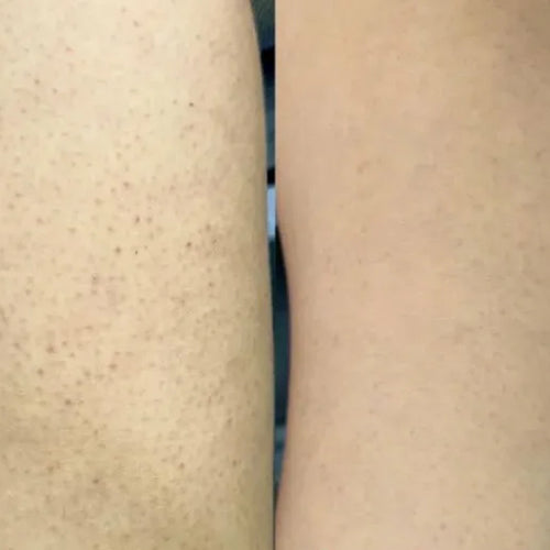 Isabell's result using the keratosis pilaris kit – reduction of bumps on thighs