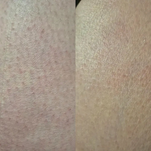 Close-up of skin after keratosis pilaris treatment – Carolin's result