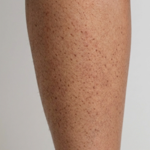 Close-up of keratosis pilaris – rough bumps on upper arms