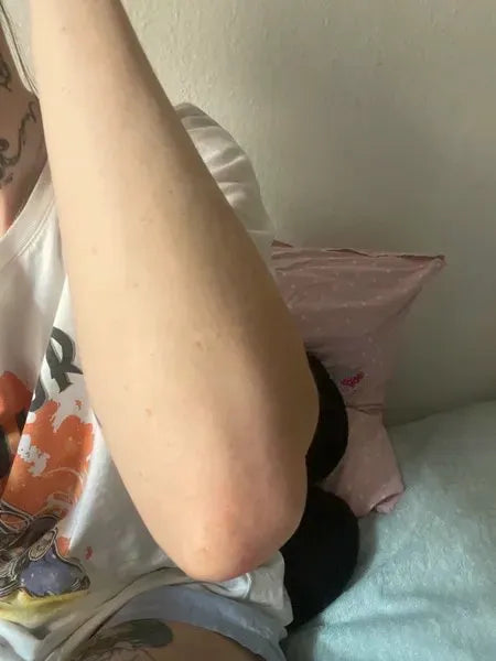 Keratosis pilaris customer result – Lisa A. from France