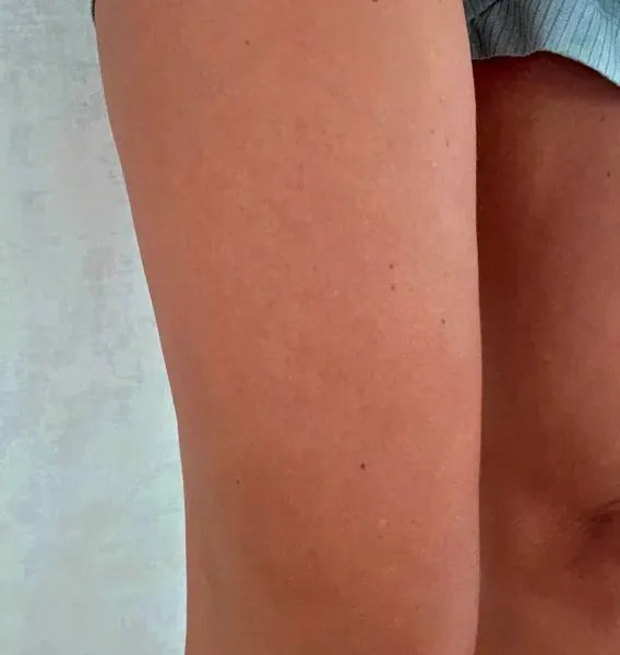 Keratosis pilaris customer result – Sarah S. from Sweden