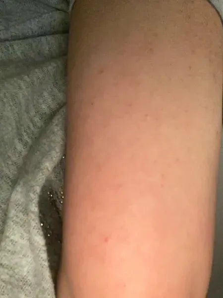 Keratosis pilaris customer result – Shaian H. uses Australian Bodycare