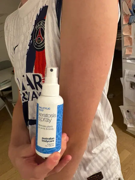 Keratosis pilaris result – 70% reduction of bumps after 3 weeks