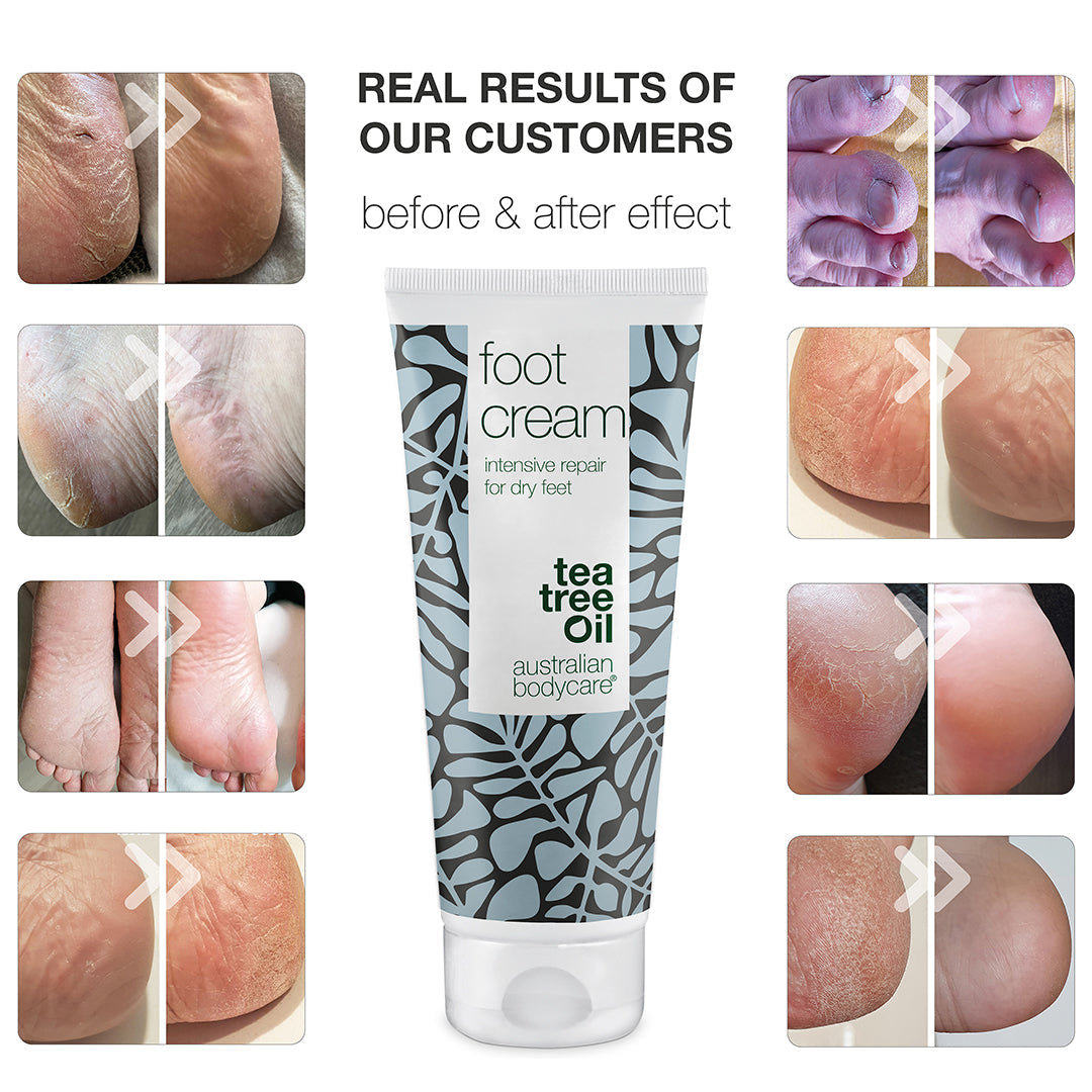 Best foot cream deals for hard skin uk